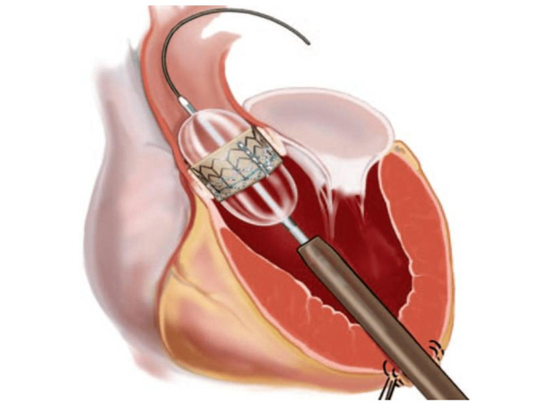 IOT Temperature and Humidity Monitoring in Prosthetic Valve Storage
